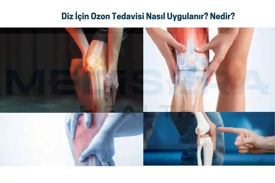 diz ozon tedavisi