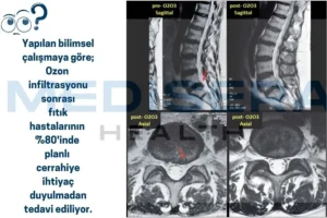 ozon tedavisi faydaları