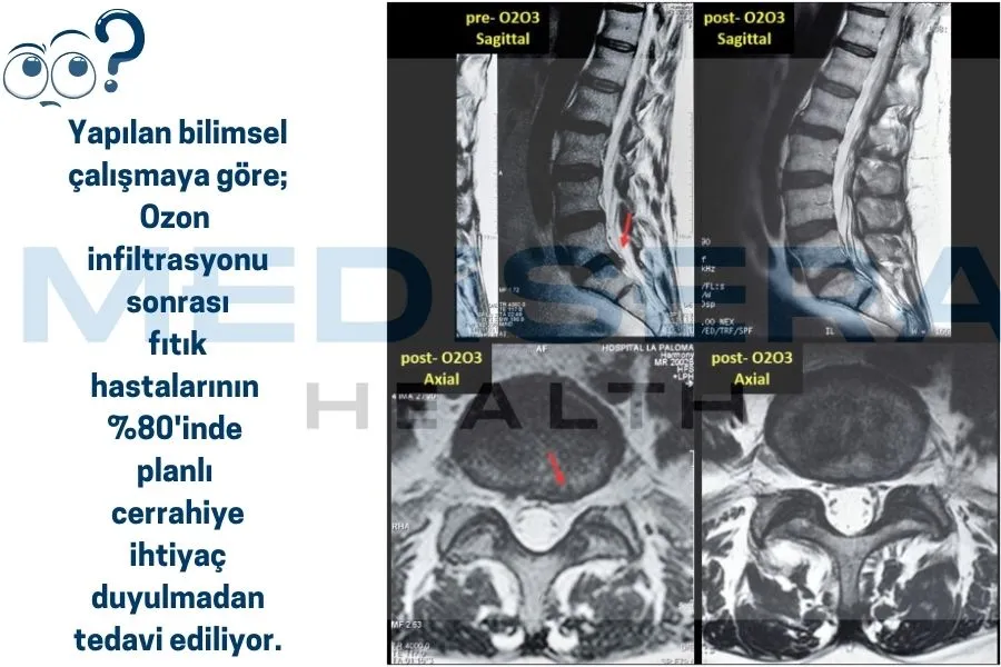 ozon tedavisi faydaları