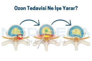 ozon tedavisi ne işe yarar