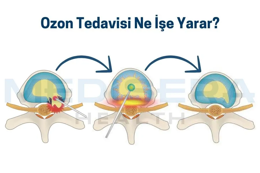 ozon tedavisi ne işe yarar