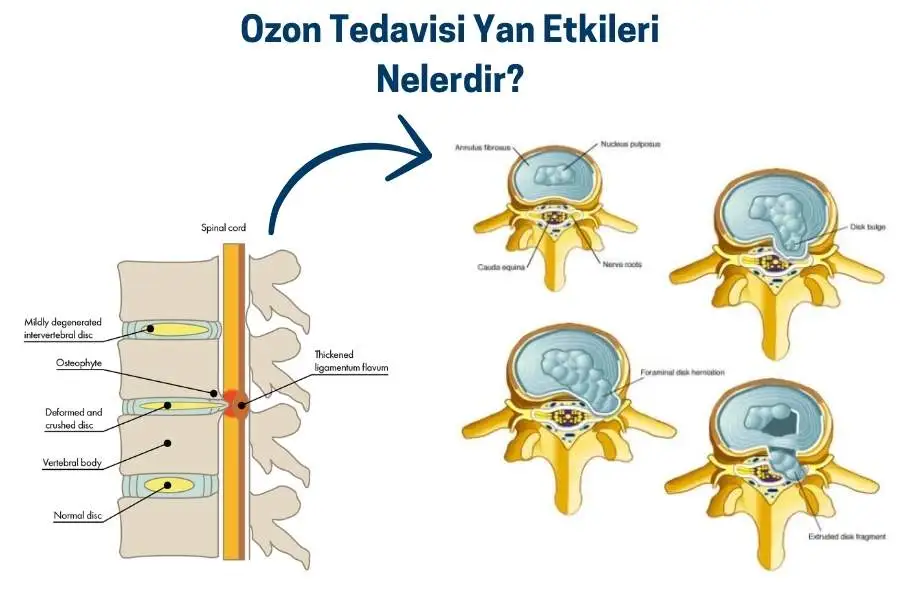 ozon tedavisi yan etkileri nelerdir
